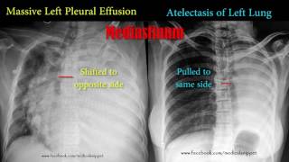 pleural effusion vs atelectasis