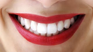 วีเนียร์ (Veneers) ทำฟันสวยแบบดารา