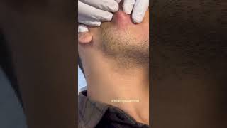 Subcision for acne scars.  #trending #bestdermatologist #subcision #acnescars #explorepage