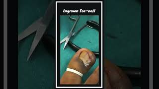 Ingrown Toenail Removal ! @DesignerDoctor  #shorts #ingrown_toenail #nailart #satisfying