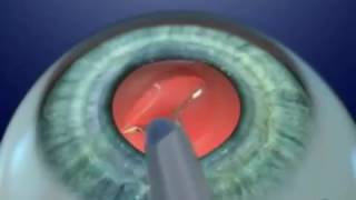 Implante de lentes intraoculares