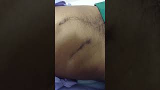 Incisional hernia at site of appendicectomy