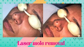 Laser mole removal By Dr Arif Iqbal || Metrocare hospital