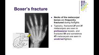 fractures of ✋ hand + wrist|anatomy shelf notes|fcps part-1 preparation forum|cpsp syllabus