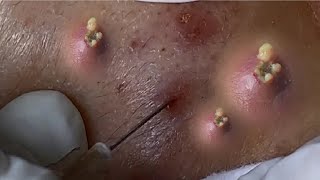 Big Cystic Acne Blackheads Extraction Blackheads & Milia, Whiteheads Removal Pimple Popping 3