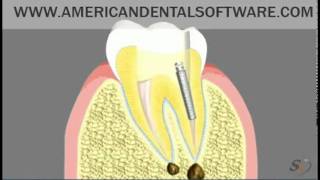 Endodontie.flv