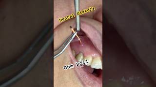 Dental fistula (also called a parulis or a gum boil)