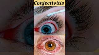 conjectivitis short knowledge