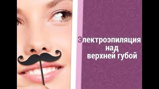 Электроэпиляция над верхней губой | Отзывы