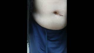 11 days after hernia surgery 18th Sep 2023 Stomach swelling down alot Can hardly tell excpt top scar