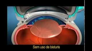 LenSx Laser é no ISO OLHOS