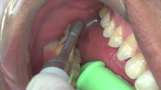 NSK Perio Mate Powder cleaning of subgingival area