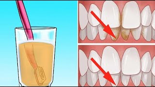 Voici comment blanchir les dents naturellement avec du vinaigre de pomme