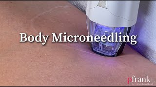 Advancements in Body Microneedling