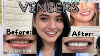 PORCELAIN VENEERS  Journey! Worth it ba?(procedure,cost,experience,advantages & disadvantages)