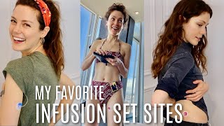 My Favorite Insulin Pump Infusion Set Sites | She's Diabetic