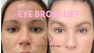 Eyebrow Lift Before And After with Dr. Nina Bal 💗 Brow Lift London UK