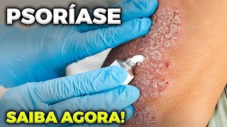 PSORÍASE: CAUSAS E TRATAMENTOS