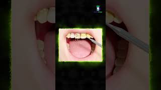 3/15 Healthy gums: What is a plaque? - பல் படலம் என்றால் என்ன? | Dr.Karthikeyan | Denta Kings