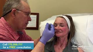 Juvederm Facial Rejuvenation - Reno Sparks MedSpa - Dr. Calvin Van Reken