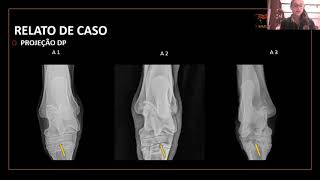 #27 "OSTEOARTRITE TÁRSICA JUVENIL EM POTROS DA RAÇA MANGALARGA MARCHADOR – RELATO DE CASO"