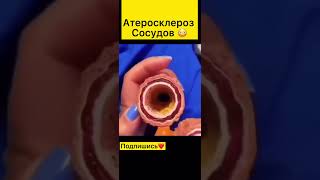 Атеросклероз сосудов!! Наглядный макет сосуда с холестериновым бляшкам.