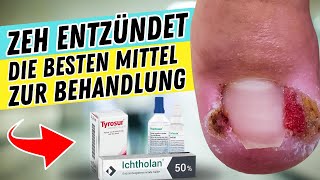 ZEH ENTZÜNDET? So behandelst du ihn | Die besten Mittel gegen ENTZÜNDETE ZEHEN & NAGELBETTENTZÜNDUNG