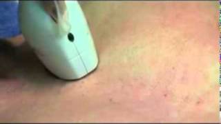 Laser Hair Removal Treatment, Ipl Hair Removal, Dallas, (87