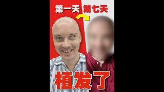 看看老外在中国植发的效果… 都让我哭了!!