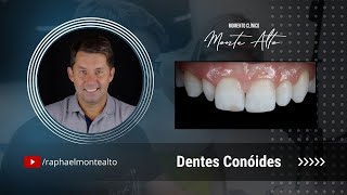 Dentes Conóides