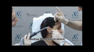 Botox Demonstration 22 Crow's Feet - A E Skin - Encino, CA - 818-835-1833