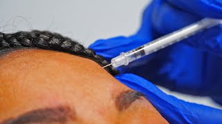 Botox Procedure At A Local Med Spa In San Antonio, Texas!