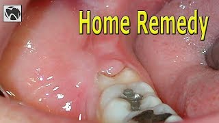 Pericoronitis Home Remedy | Best Pericoronitis Treatment at Home | Wisdom Teeth