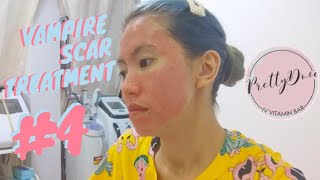 SESSION 4 VAMPIRE FACIAL SCAR TREATMENT | PRETTYDOSE