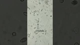 Crystals in urine sample under microscopic examination || Ovoid calcium oxalate monohydrate