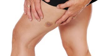 10 Natural Remedies to Speed Bruise Healing