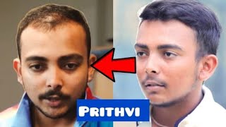 Prithvi Shaw|Hair transplant| Results| Minoxidil| Finasteride| hair fall| hindi| receding|regrowth