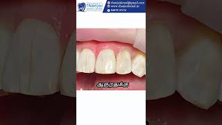 பற்கள் ல brown color கோடு வரதுக்கு என்ன காரணம்? | Thanjai Dental Centre #thanjavur #dentalcare