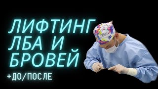 Подтяжка лба и бровей | Видео с операции + ДО/ПОСЛЕ