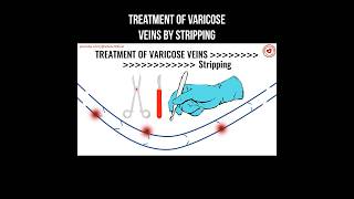 Treatment of varicose veins by stripping #varicoseveins #stripping #varicoseveinstreatment #veins