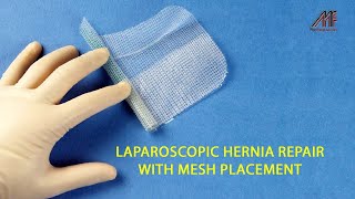 How to do Laparoscopic Hernia Repair with Mesh Placement tips and tricks