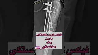 جراحی شکستگی خرد شده مچ دست. دکتر حسین رونقی متخصص ارتوپدی رشت