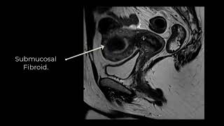 Fibroids Case 3.mp4