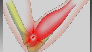 Tennisarmbåge -- en ergonomisk utmaning