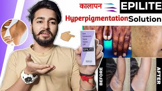 Epilite Solution Review  | Solution For Pigmentation, Melasma