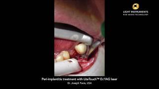 Peri implantitis treatment with LiteTouch™ Er:YAG laser