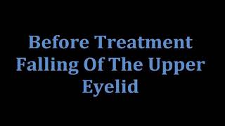 Acupuncture Treatment for Pathologic droopy eyelid