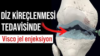 Diz kireçlenmesine ne iyi gelir ! Dizde Sıvı Kaybı DİZ KİREÇLENMESİ TEDAVİSİ İğne Yapılması