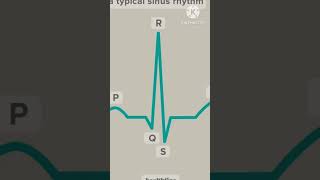 #shorts #ecg  Normal Sinus rhythm