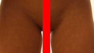 Labia Majora Rejuvenation with Fat Injections